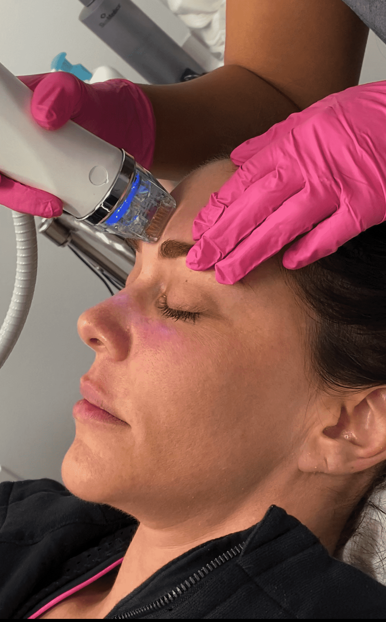 Cosmetic Treatments 15 Laser Hair Removal in Abu Dhabi with Candela Gentle Pro Max