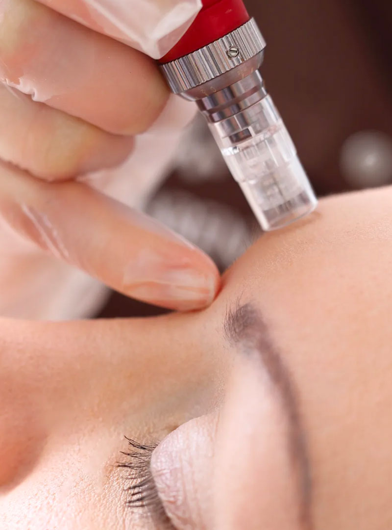 Aesthetic Clinic in Abu Dhabi 7 Microneedling Abu Dhabi - smooth youthful skin