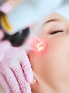 Carbon Laser Facial 2 Laser skin rejuvenation for brighter and smoother face skin