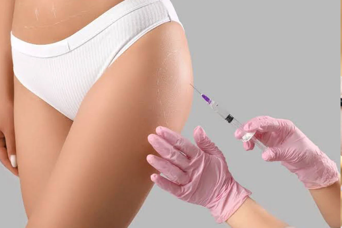 Brazilian Butt Lift BBL 1
