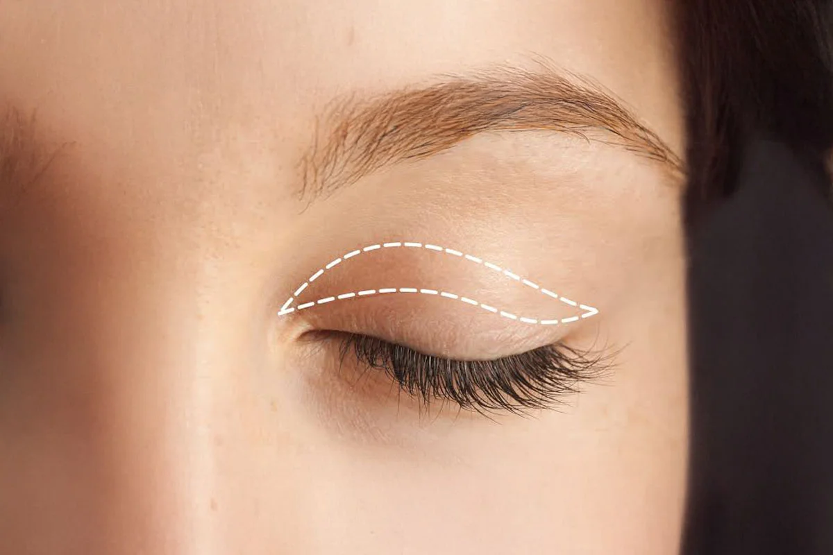 Eyelid Surgery Blepharoplasty