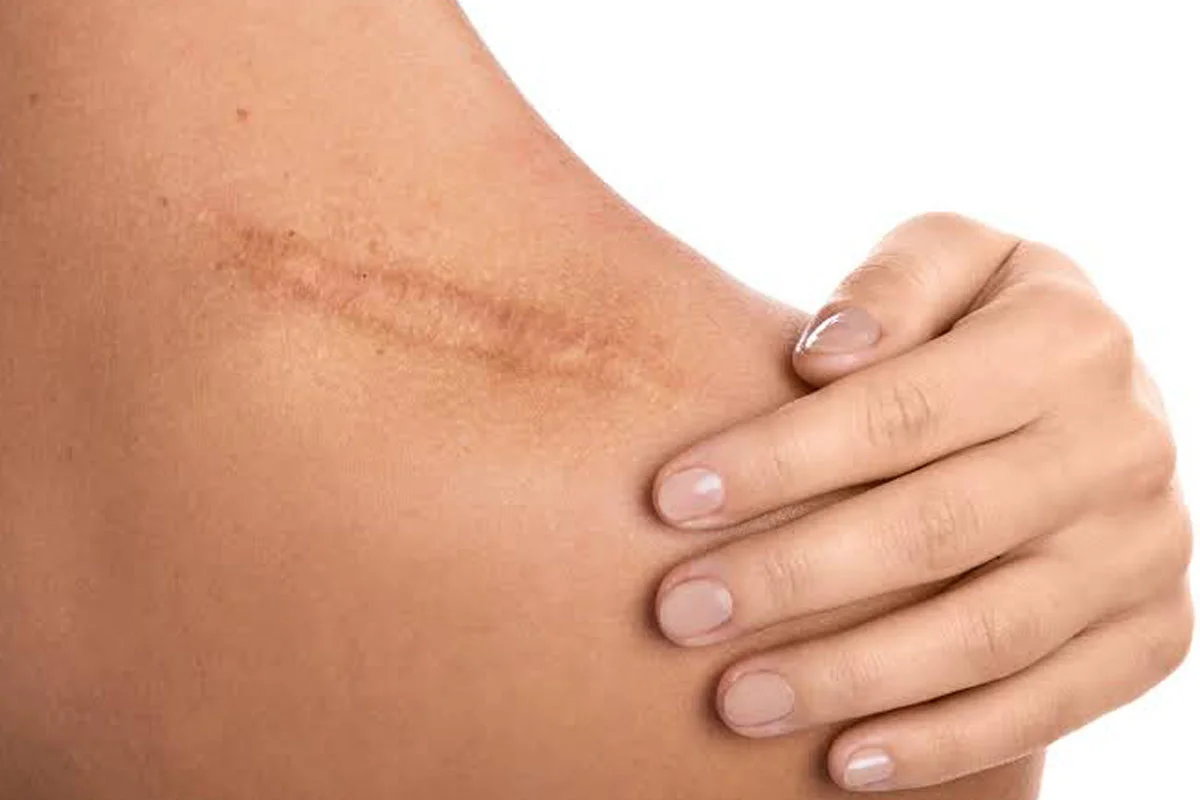 Scar Revision Keloid Treatment