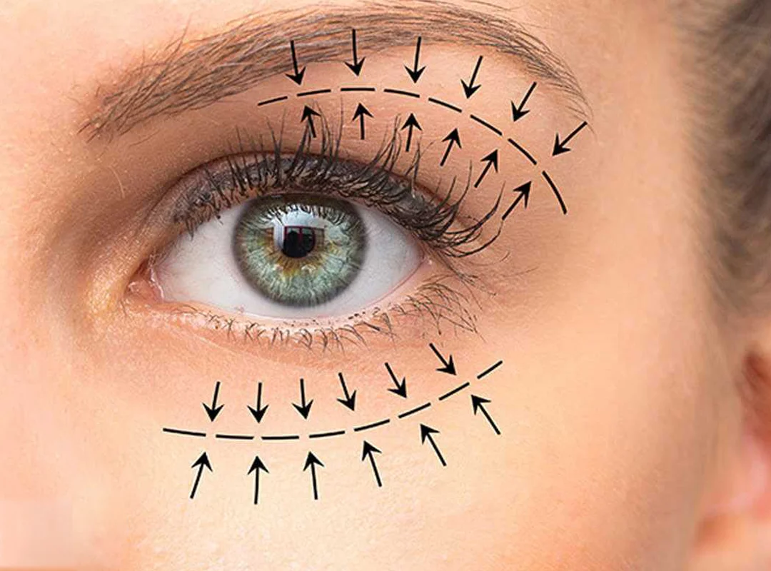 عملية تجميل الجفون الحل للجفون المتهدلة وأكياس تحت العين